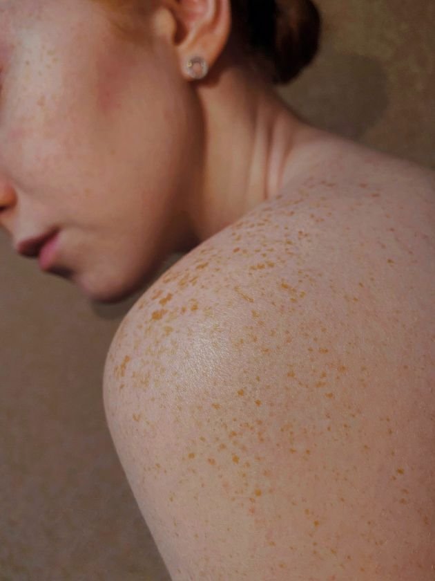 Skin type